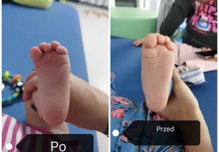 Dwa zdjęcia stopy dziecka: po lewej stopa sierpowata, po prawej ta sama stopa po terapii.