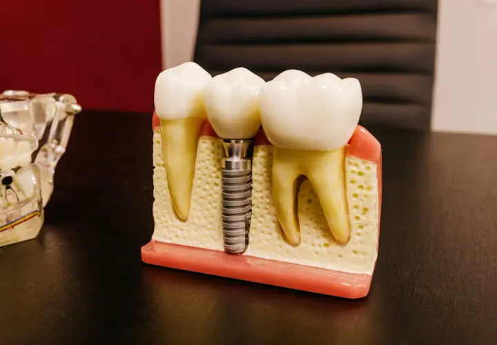 Model szczęki z zębami, gdzie jeden z nich zastąpiono przez mini implant ortodontyczny.
