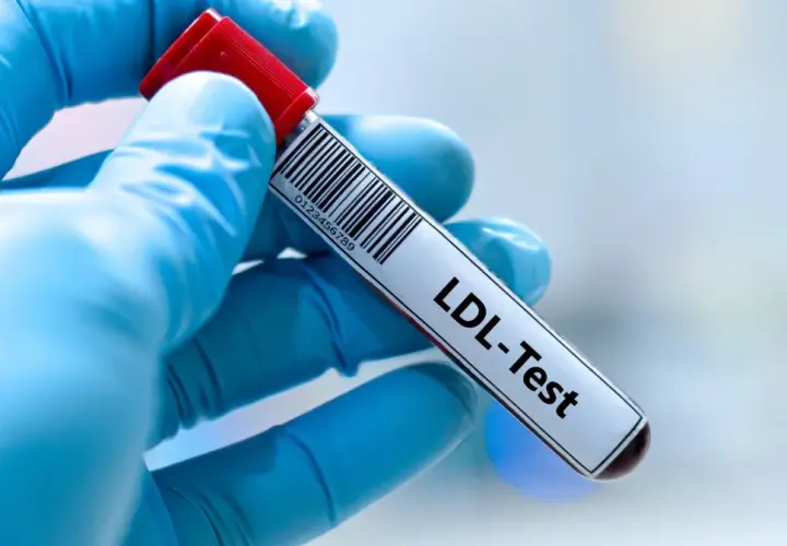 Ręka w niebieskiej rękawiczce trzyma probówkę z oznaczeniem "LDL-Test". Wynik badania wskazuje na podwyższony cholesterol LDL.