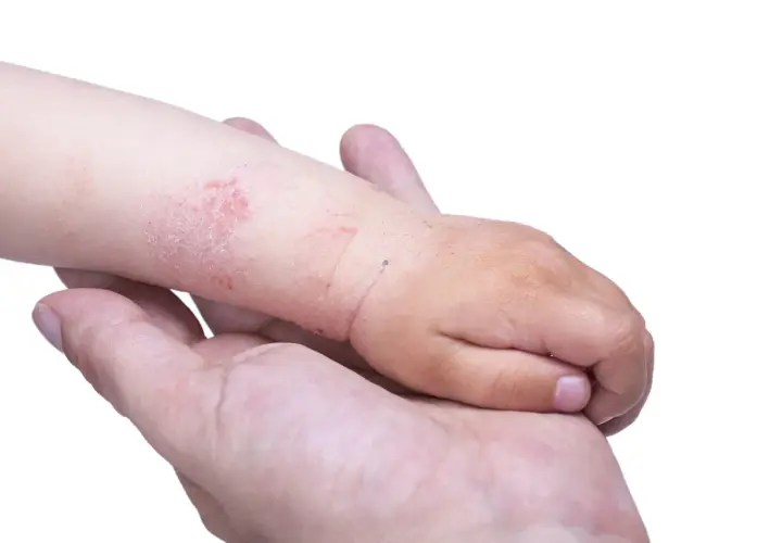 Mano di un adulto che tiene il braccio di un bambino con eczema. La pelle del bambino è arrossata e screpolata, mostrando i segni tipici dell'eczema nei bambini.