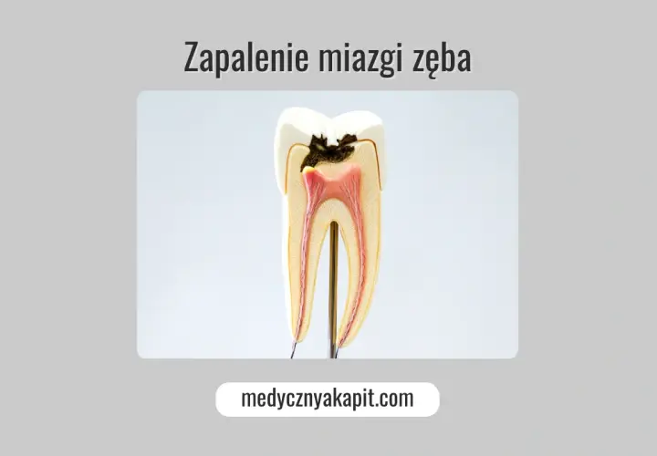 Przekrój zęba ukazujący próchnicę sięgającą do miazgi zęba, która jest zaczerwieniona i zaogniona.