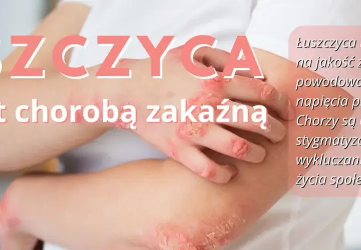 Łuszczyca na łokciach i dłoniach. Choroba nie jest zakaźna, ale wpływa na jakość życia i może prowadzić do napięcia psychicznego.