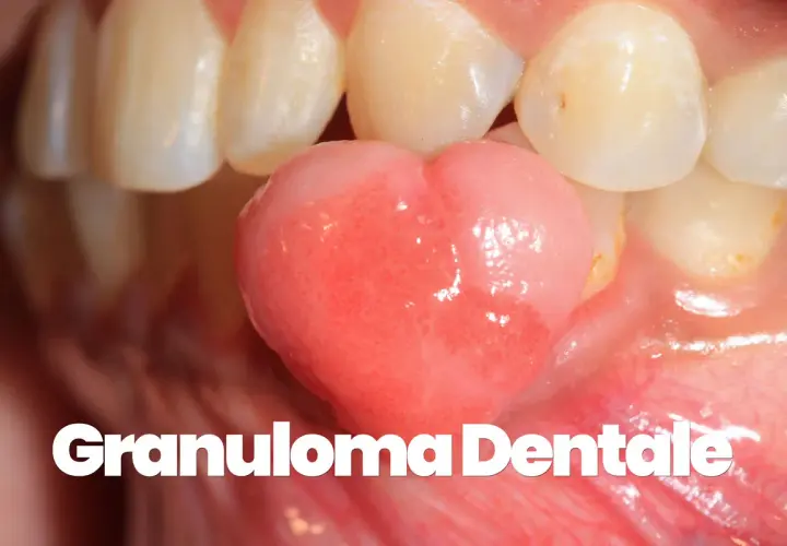 Un granuloma gengivale, una piccola protuberanza rosa, cresce tra i denti.