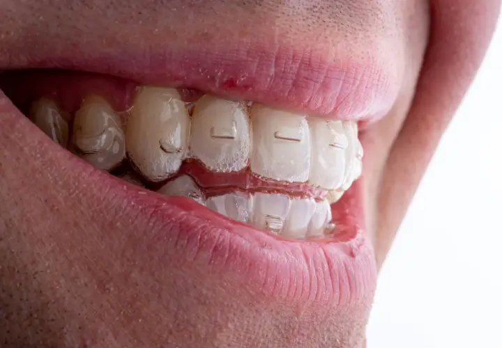 Uśmiech z przezroczystymi nakładkami Invisalign. Zastanawiasz się nad Invisalign cena? To dyskretne rozwiązanie dla prostych zębów.
