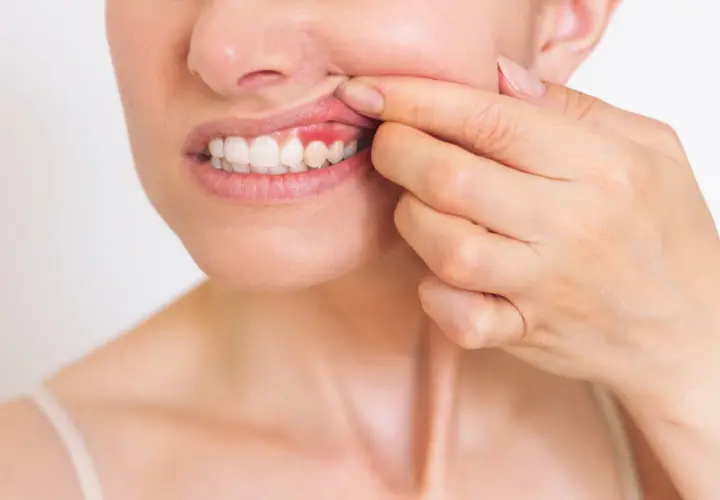 Donna mostra una gengiva gonfia e rossa, possibile conseguenza di una devitalizzazione dentale.