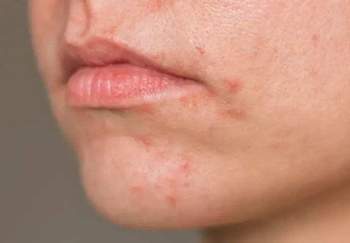 Haut um den Mund mit Rötungen und Pickelchen. Periorale dermatitis nulltherapie hilft nicht, die Haut ist gereizt.