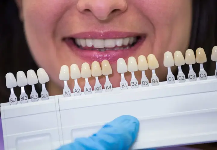 Selezione del colore per denti rifatti perfetti. Un sorriso smagliante inizia dalla scelta giusta.