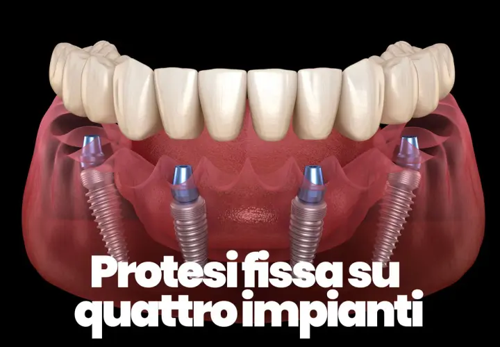 Protesi fissa su quattro impianti dentali, mostrando la struttura ossea e i pilastri che sostengono i denti.