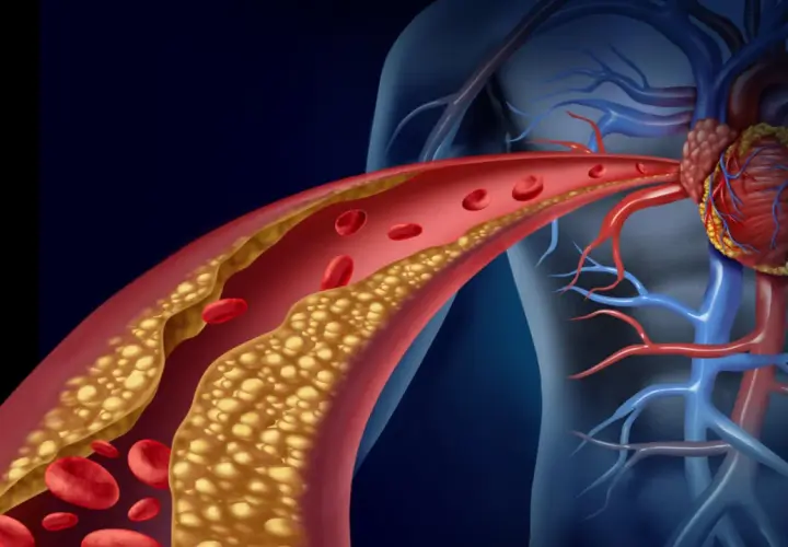 Zaburzenia lipidowe (dyslipidemia) to stan, gdy we krwi jest za dużo złego cholesterolu, co prowadzi do zwężenia naczyń krwionośnych i problemów z sercem.