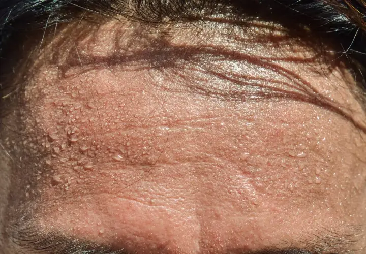 Frente sudorosa, con gotas de agua brillando. ¿Buscas trucos para no sudar por la cabeza?