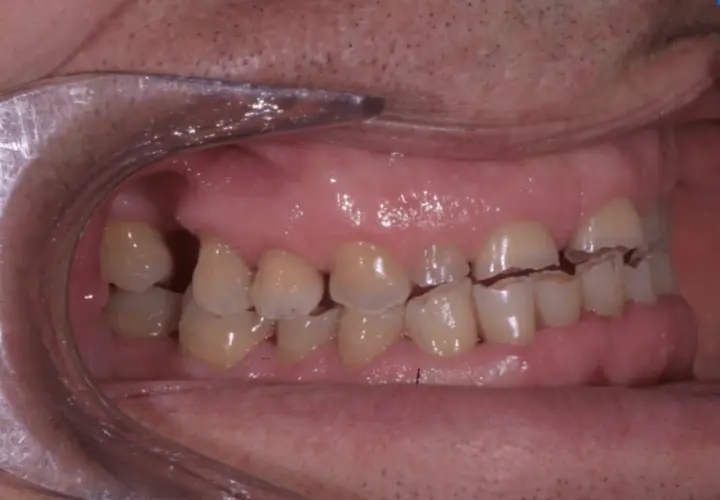 Denti con segni visibili di erosione dentale, con smalto consumato e bordi irregolari.