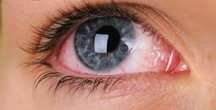 Occhio congiuntivite: arrossamento e secrezioni indicano possibili cause virali o batteriche.