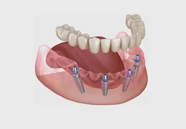 Immagine di protesi dentali fisse su impianti, una soluzione innovativa per chi cerca impianti dentali senza bucare osso.