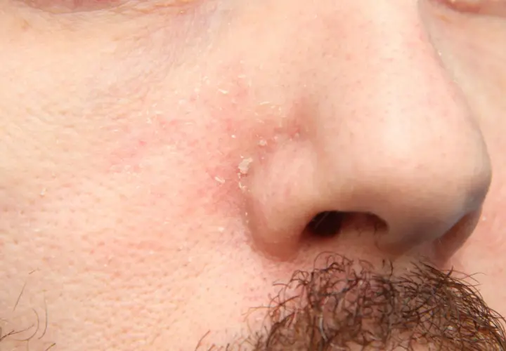 Piel enrojecida y escamosa alrededor de la nariz y la barba, indicativo de dermatitis seborreica barba.