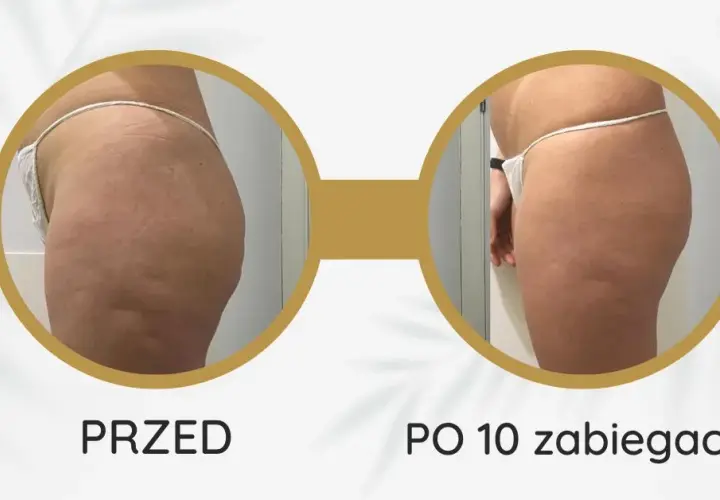 Endermologia: Gładka skóra bez cellulitu? Poznaj efekty i fakty