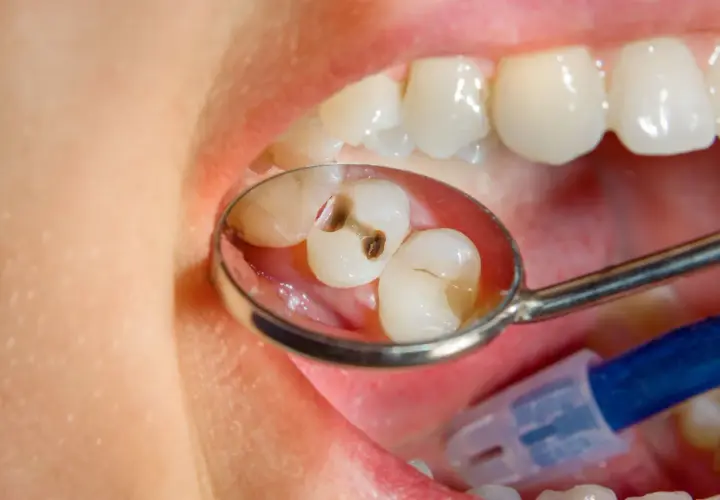 Specchio dentale riflette due denti con evidenti carie. Un dente ha una cavità scura, l'altro mostra un'area danneggiata.