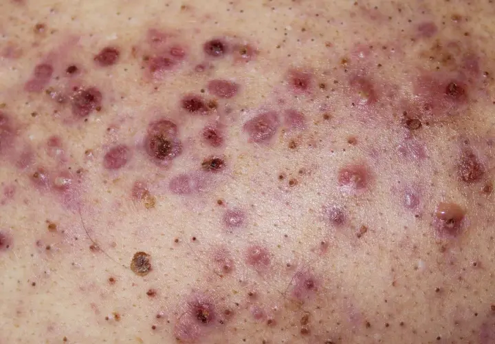 Piel con múltiples pápulas, pústulas y nódulos inflamados, característicos del acne conglobata.