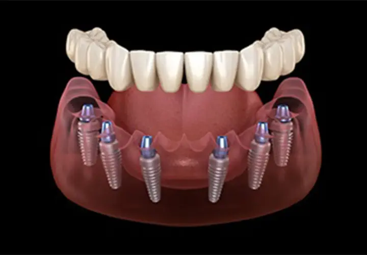 Modello 3D di un impianto dentale fisso con sei viti inserite nell'osso mascellare, pronte a sostenere una protesi dentale.
