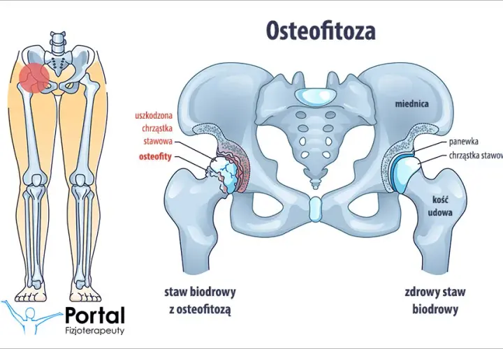 Osteofitoza: Jaka rehabilitacja? Odzyskaj sprawność i zwalcz ból!