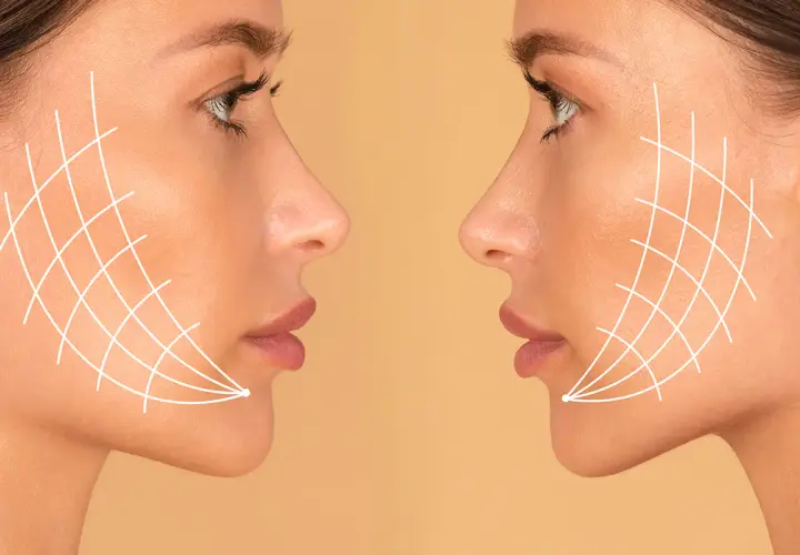 Dos perfiles de mujer con líneas blancas que simulan el efecto de un tratamiento facial. El antes y después de Thermage FLX para una piel más firme.