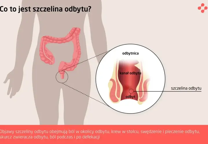 Ilustracja pokazuje anatomię odbytu z zaznaczoną szczeliną. Objawy szczeliny odbytu to ból, krwawienie i pieczenie.