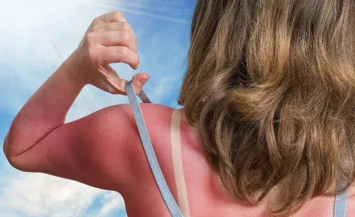 Skuteczne leki na oparzenia słoneczne, które przyniosą ulgę i szybkie wyleczenie