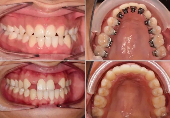 Denti con agenesia dentale, alcuni con apparecchio ortodontico, in diverse viste.