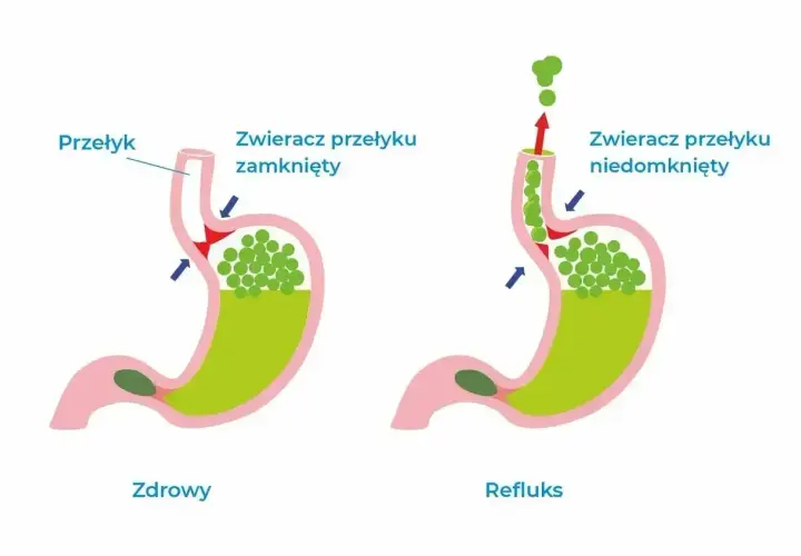 Zdrowy żołądek vs. refluks. U zdrowego zwieracz przełyku jest zamknięty, a przy refluksie niedomknięty, co powoduje cofanie się treści żołądkowej i uczucie guli w gardle.