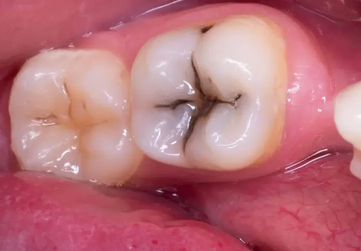 Dente con carie profonda che necessita di cure. La cavità scura è ben visibile nella fessura centrale.