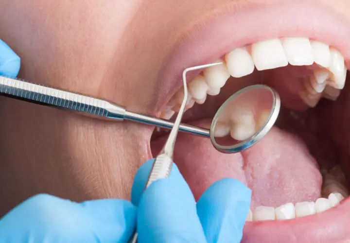 Bocca aperta con strumenti dentistici. La pulizia dei denti fa male? Forse, ma necessaria per un sorriso smagliante.