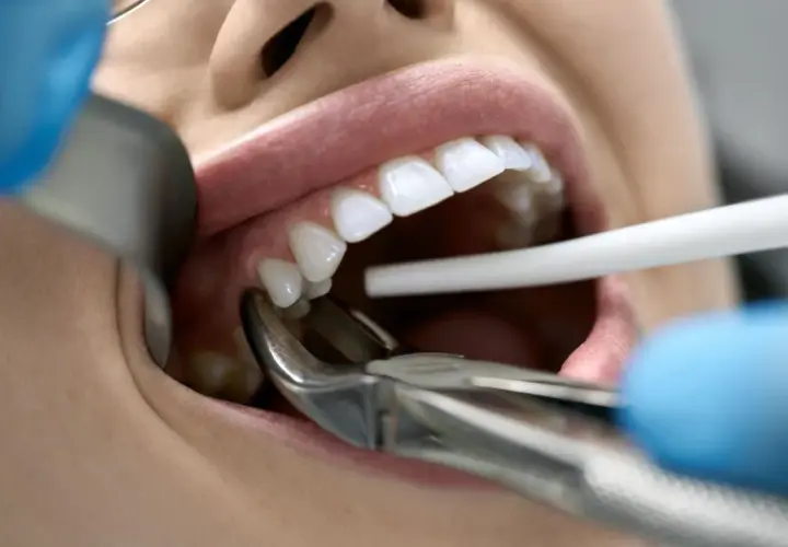 Dentysta usuwa ząb z powodu choroby. Widoczne są kleszcze dentystyczne i białe zęby.