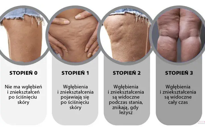 Jak pozbyć się cellulitu? Kompletny przewodnik po domowych i zabiegach