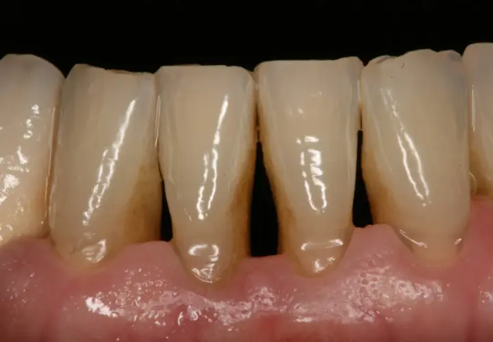 Dientes con acumulación de sarro y encías inflamadas, signos de periodontitis causas.