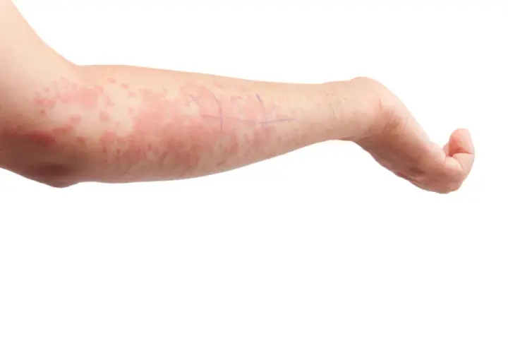 Braccio di un bambino con eruzioni cutanee rosse e pruriginose, indicative di orticaria neonato. Segni viola indicano aree di test.