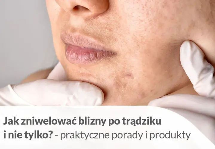 Skóra z bliznami po pryszczach, z tekstem "Jak zniwelować blizny po trądziku i nie tylko?".