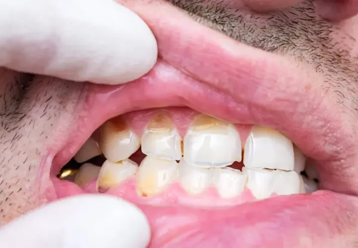 Dientes con manchas y aspecto desgastado, sugiriendo hipoplasia dental.