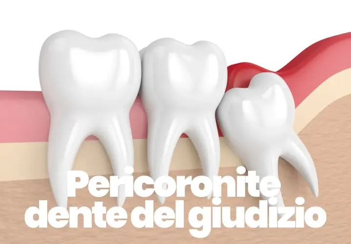 Dente del giudizio parzialmente coperto dalla gengiva, causa di pericoronite.