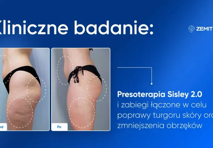 Przed i po zabiegu presoterapii Sisley 2.0. Widoczne spektakularne presoterapia efekty: poprawa jędrności skóry i redukcja obrzęków.
