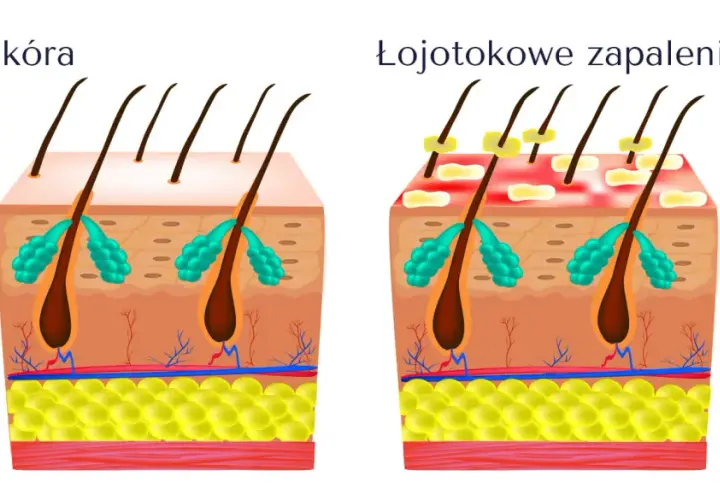 Ilustracja porównująca zdrową skórę głowy z łojotokowym zapaleniem skóry, pokazująca mieszki włosowe i gruczoły łojowe.