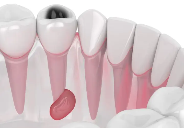 Dente cariato con ascesso gengivale. Si cercano rimedi della nonna, ma la situazione richiede attenzione medica.