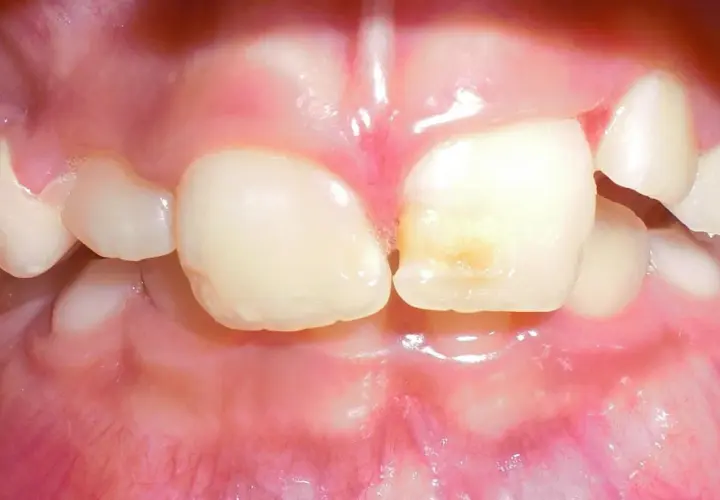 Dientes infantiles con caries incipiente. El flúor ayuda a fortalecer el esmalte y previene futuras caries.