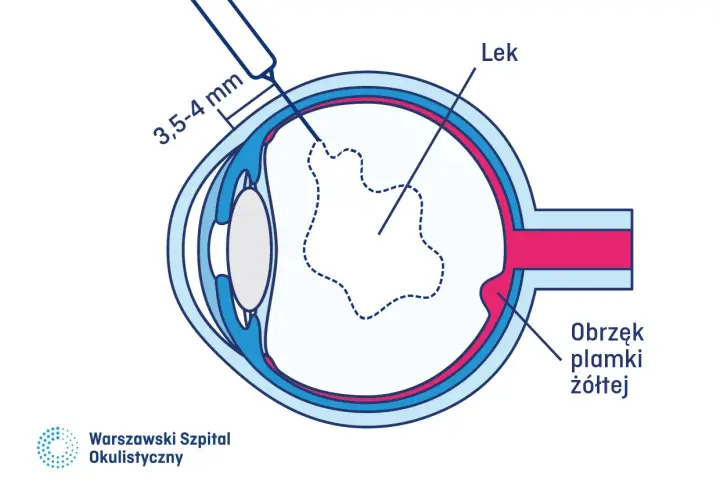Ilustracja przedstawia iniekcje doszklistkowe, podanie leku do oka w celu leczenia obrzęku plamki żółtej.