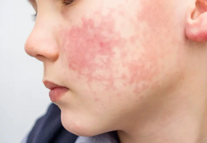 Visage d'enfant marqué par une rougeur diffuse et des plaques, symptômes de dermatite atopique aggravée par la transpiration.