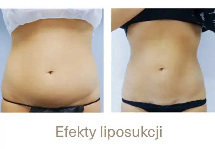 Po liposukcji tłuszcz wraca? Nie! Jak utrzymać nową sylwetkę