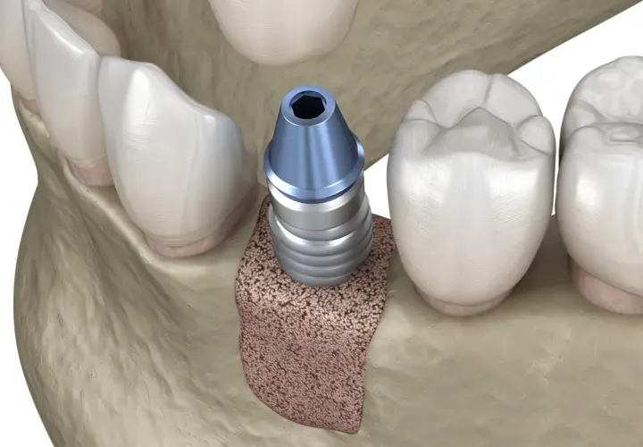 Impianto dentale inserito nell'osso mascellare, pronto per l'integrazione. L'osso autologo offre una base solida per il successo del trattamento.