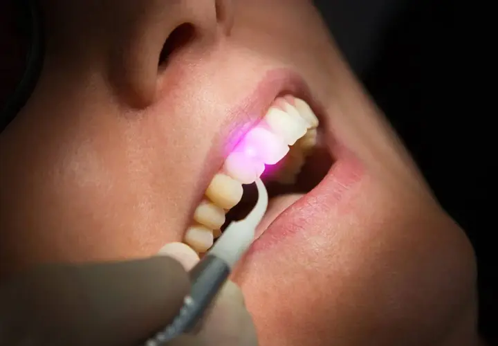 Trattamento gengivale con laser, un raggio rosa illumina i denti e le gengive.