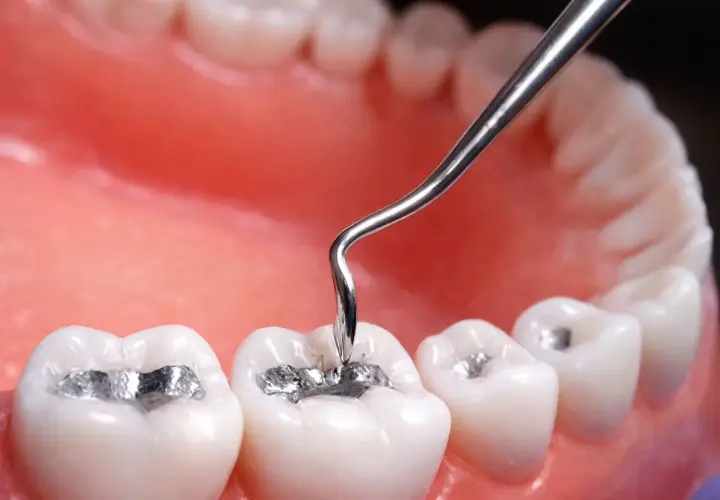 Un dentista aplica una amalgama dental a una muela.