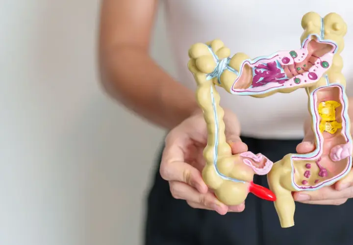Model jelita grubego z widocznymi zmianami, które mogą być związane z ibs objawy.