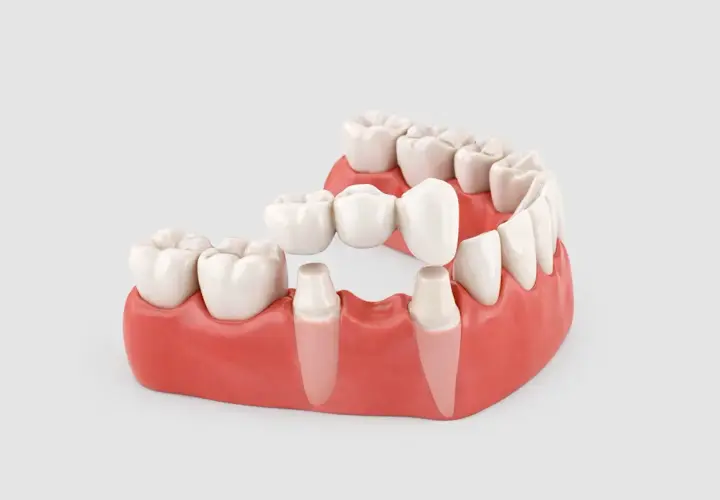Modello di un ponte dentale con ganci che sostituisce un dente mancante, ancorato a pilastri naturali.