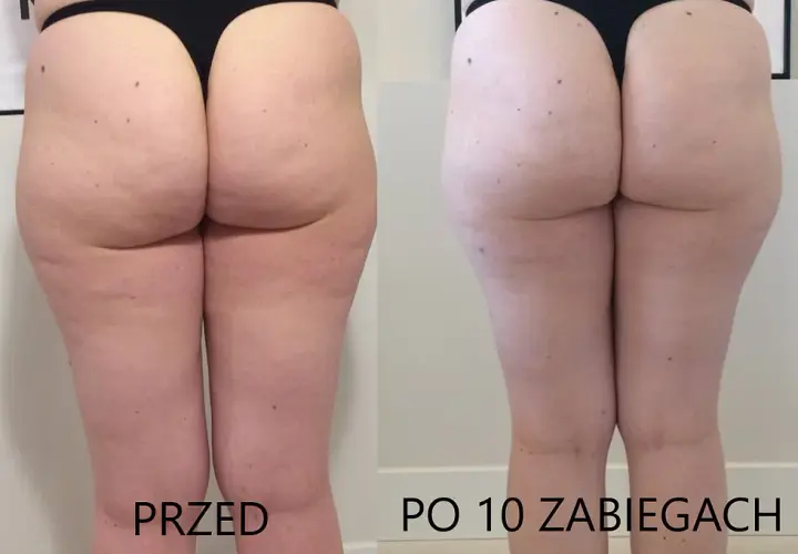 Masaż bańką chińską na cellulit: Instrukcja krok po kroku i efekty